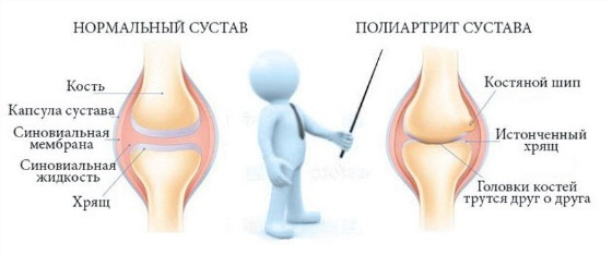 [Игорь Кауфман] Реаматоидный полиартрит (2022)